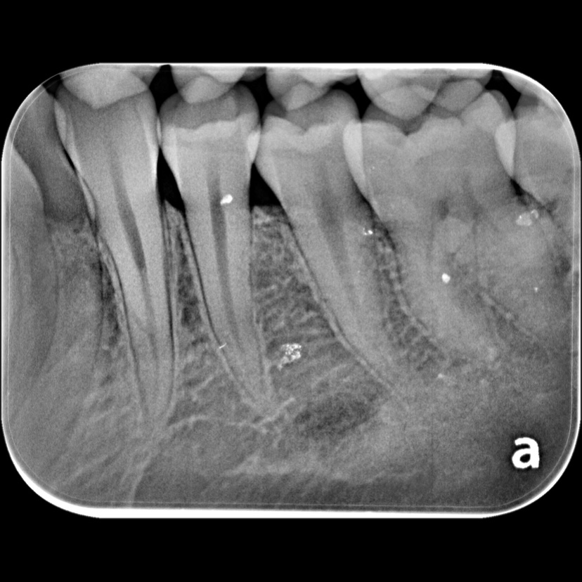 an xray of teeth